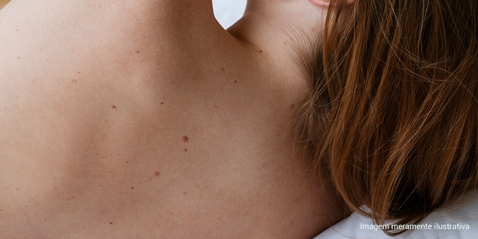 Melanoma por que ele exige mais atenção