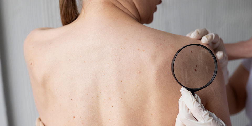 Tipos de câncer de pele: qual a diferença entre carcinoma e melanoma?
