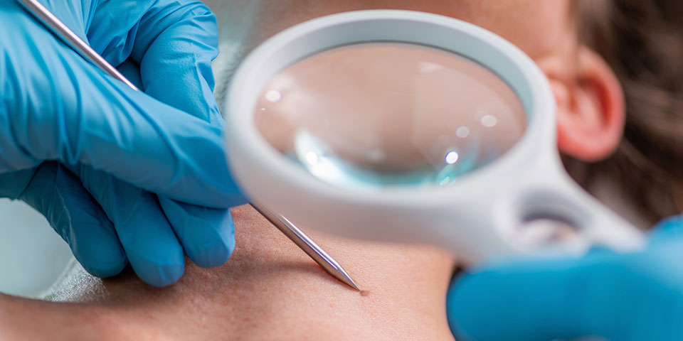 Câncer de pele - Diagnóstico do câncer de pele: biópsia, dermatoscopia e exames complementares