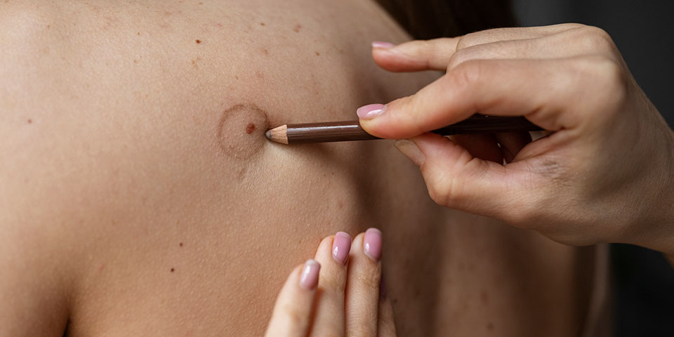 Manchas na pele também podem indicar problema de Câncer de pele ?