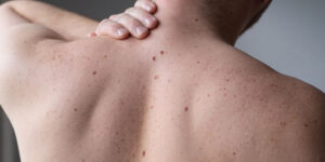 Pintas, lesões e feridas que não cicatrizam: quando devo me preocupar?